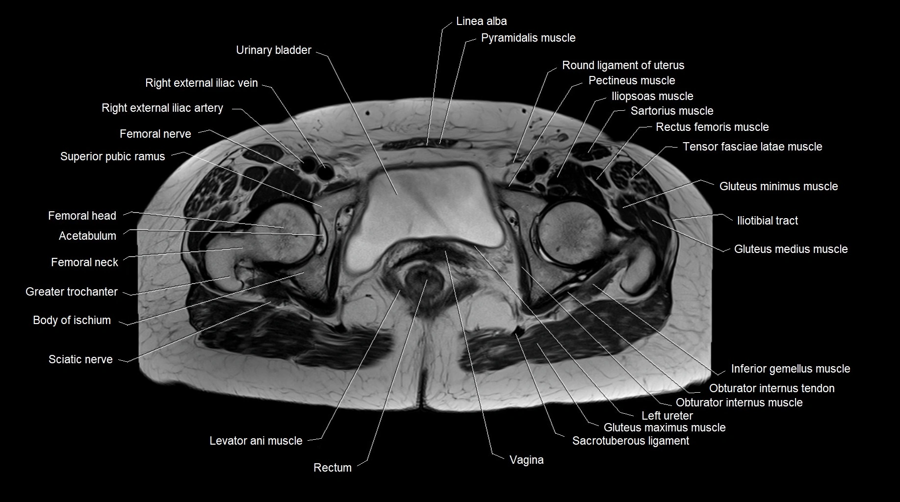 MRI 3T pelvis axial cross section anatomy image 24.webp